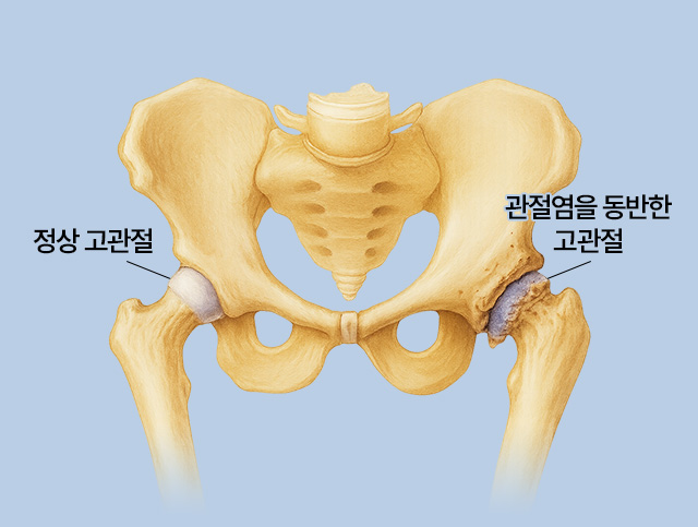 정상 고관절 / 관절염을 동반한 고관절