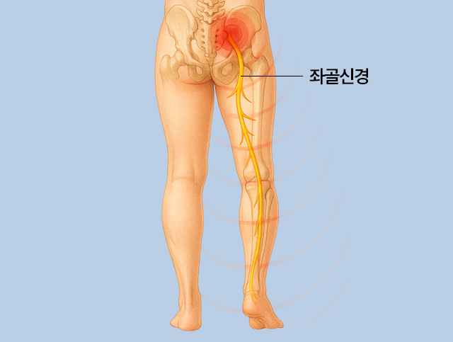 좌골신경