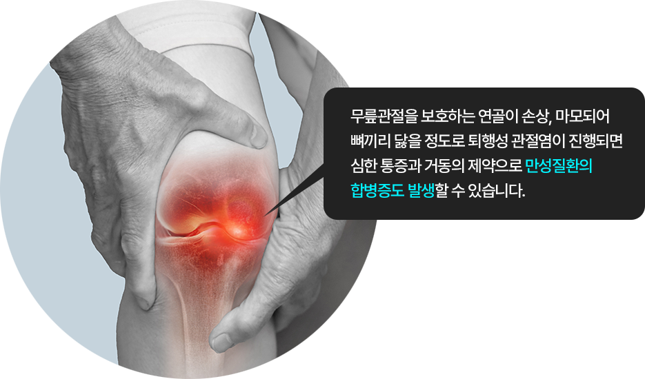 무릎관절을 보호하는 연골이 손상, 마모되어 뼈끼리 닳을 정도로 퇴행성 관절염이 진행되면 심한 통증과 거동의 제약으로 만성질환의 합병증도 발생할 수 있습니다.