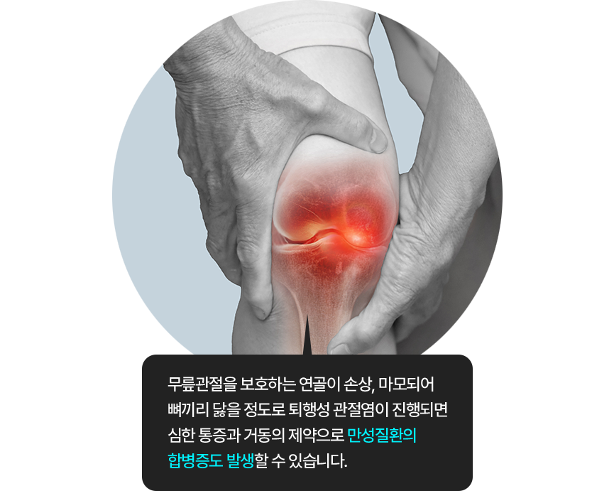 무릎관절을 보호하는 연골이 손상, 마모되어 뼈끼리 닳을 정도로 퇴행성 관절염이 진행되면 심한 통증과 거동의 제약으로 만성질환의 합병증도 발생할 수 있습니다.