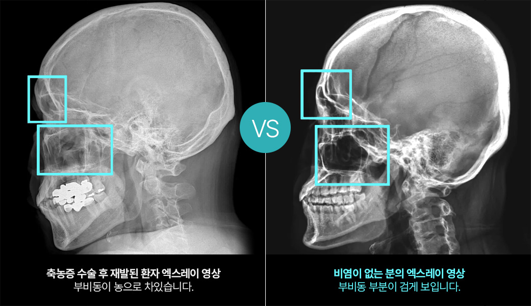 축농증 수술 후 재발된 환자 엑스레이 영상 : 부비동이 농으로 차있습니다. VS 비염이 없는 분의 엑스레이 영상 : 부비동 부분이 검게 보입니다.