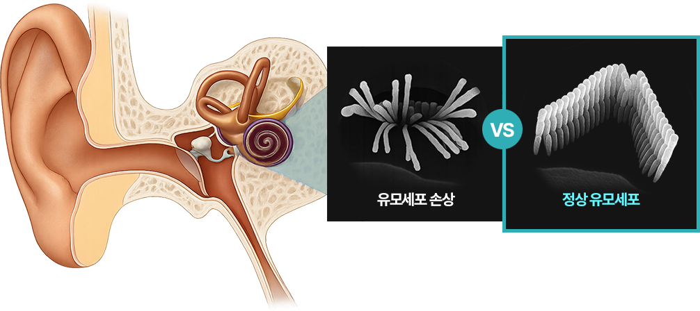 유모세포 손상 VS 정상 유모세포