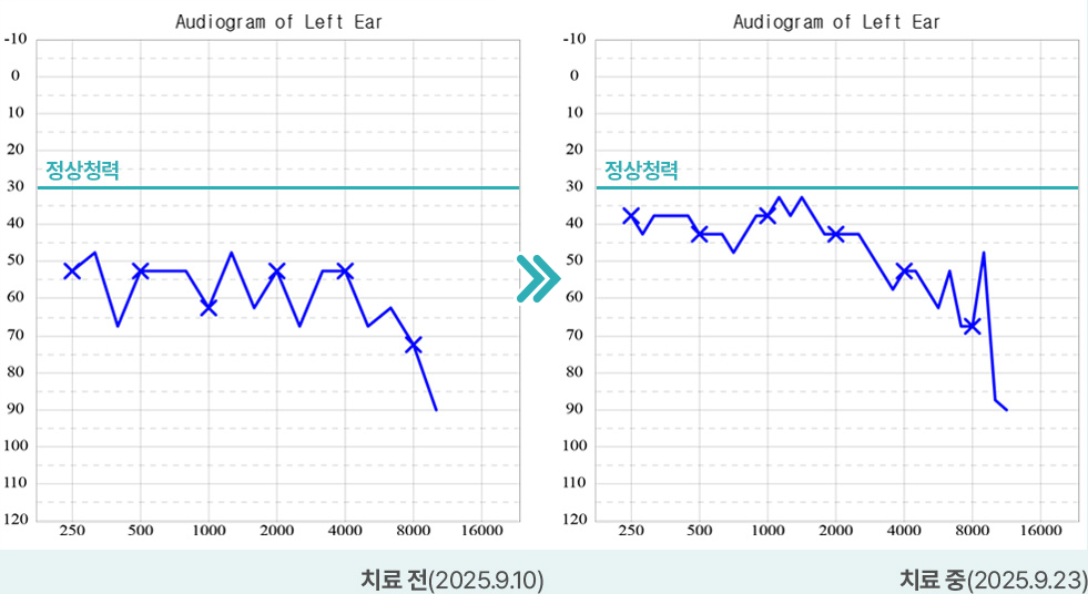 치료 전(2025.9.10) / 치료 중(2025.9.23)