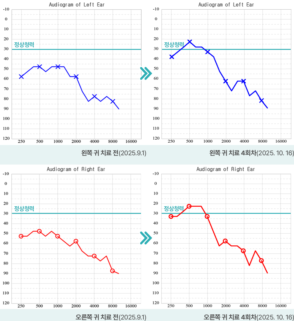 왼쪽 귀 치료전(2025.9.1) / 왼쪽 귀 치료 4회차(2025.10.16) | 오른쪽 귀 치료전(2025.9.1) / 오른쪽 귀 치료 4회차(2025.10.16)